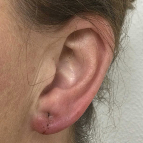 Na — Oorlel correctie