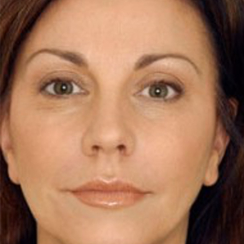 Na — Deep plane facelift