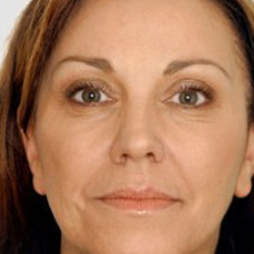 Voor — Deep plane facelift