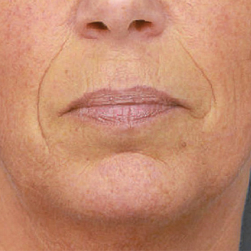 Voor — Huidverbetering fillers