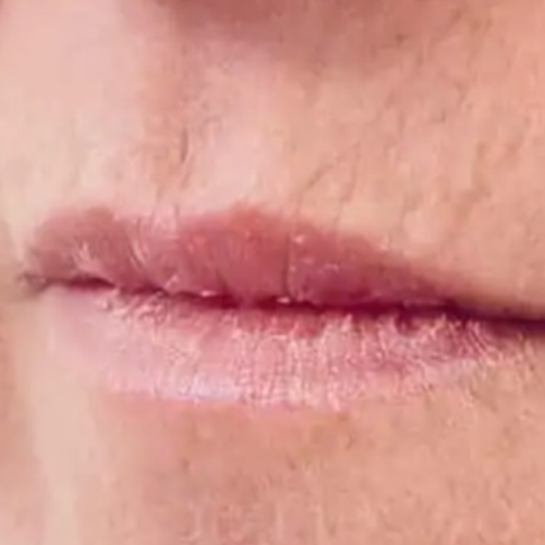 Na — Fillers rimpels