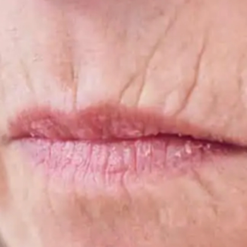 Voor — Fillers rimpels