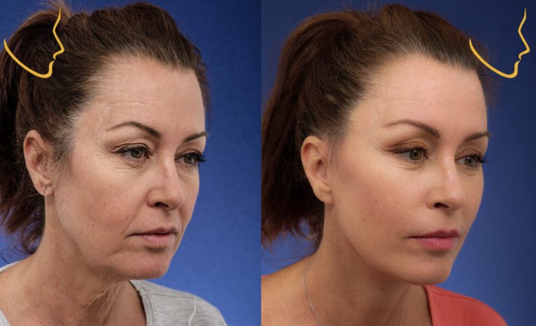 Deep Plane Facelift