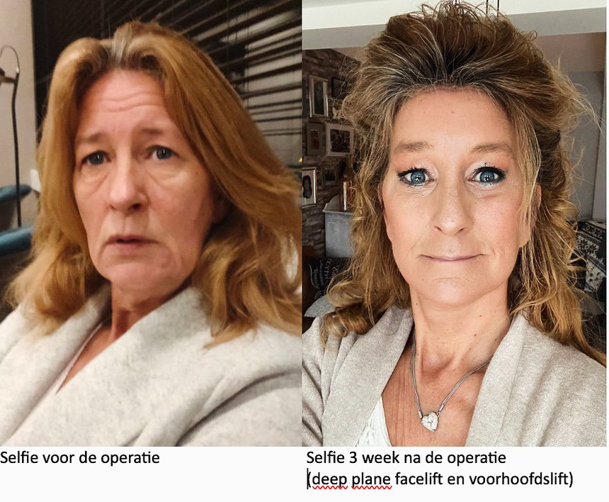 Deep Plane Facelift