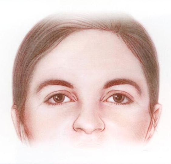 Van somber uitziende man door lage wenkbrauw stand naar man met actief natuurlijk dynamische uitstraling: minimaal 10 jaar jonger ogend door deep plane endoscopische voorhoofdslift.