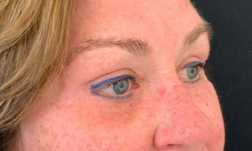Natuurlijk resultaat van een dual-plane onderooglid correctie bij een 47-jarige vrouw