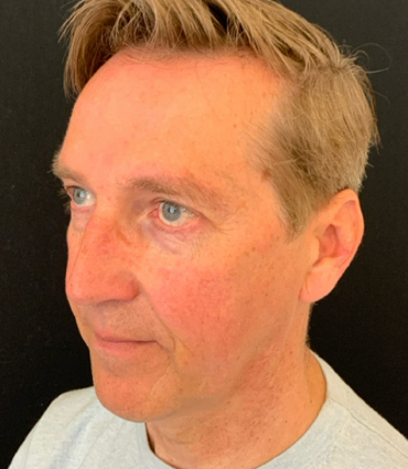 De deep plane voorhoofdslift – krachtige verj