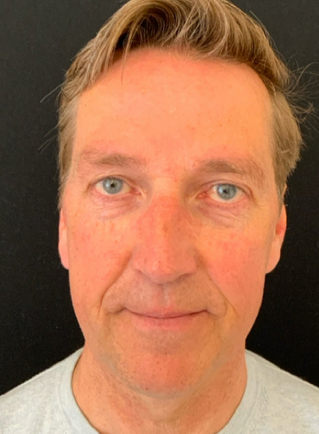 Deep plane voorhoofdslift – voor en na resultaat 3