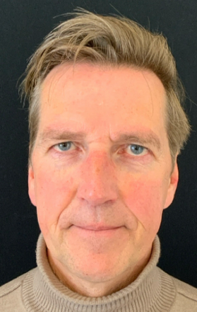 Deep plane voorhoofdslift – voor en na resultaat 1