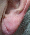 Oorlelcorrectie: alles over oorlel herstel en verjonging - Prof. Aesthetics - Prof. Dr. Berend van der Lei