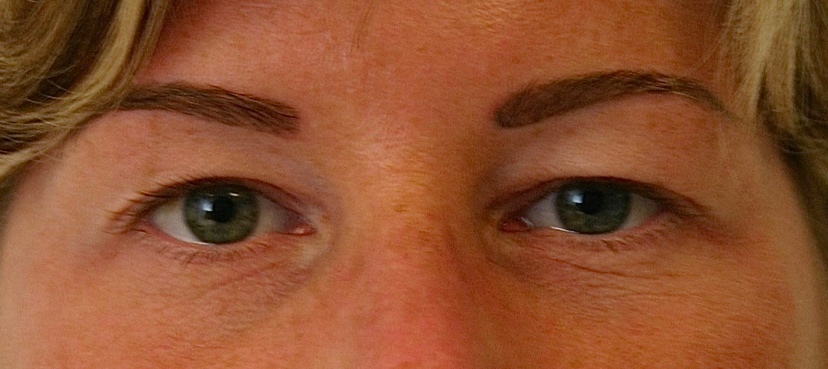 Subtiele bovenooglidcorrectie voor – 38-jarige vrouw