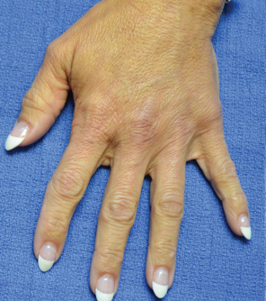 Soorten fillers en hun werking: hyaluronzuur, Profhilo en Radiesse - Prof. Aesthetics - Prof. Dr. Berend van der Lei