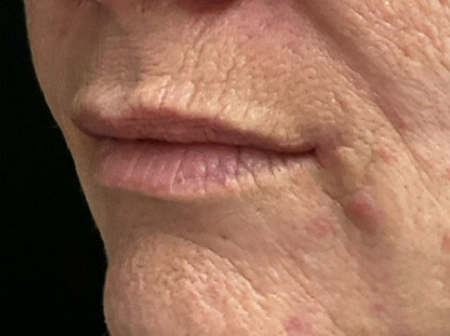 Chirurgische mondhoeklift na – 52-jarige vrouw