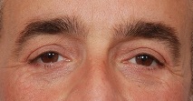 Onderooglidcorrectie bij mannen: wallen onder de ogen effectief verwijderen - Prof. Aesthetics - Prof. Dr. Berend van der Lei