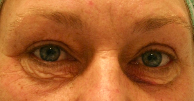 Wallen onder de ogen? Denk aan een onderooglidcorrectie