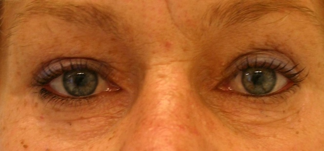 Onderooglidcorrectie na – 47-jarige vrouw