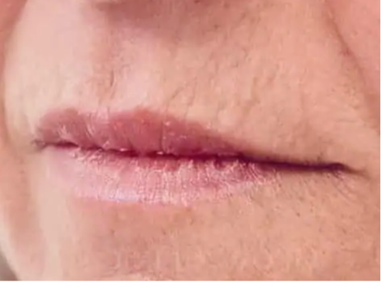Soorten fillers en hun werking: hyaluronzuur, Profhilo en Radiesse - Prof. Aesthetics - Prof. Dr. Berend van der Lei